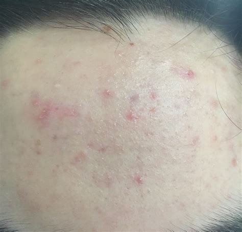 Skin Concern Acne Has Been Getting Better But Forehead Has Weird