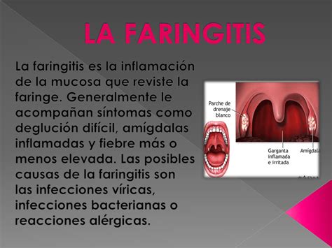 La Faringitis