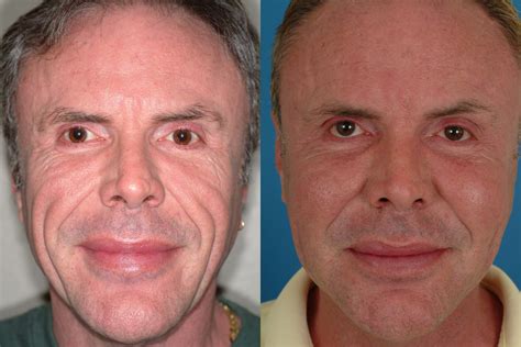Sculptra Treatment Before & After Photos | Dr. Bassichis
