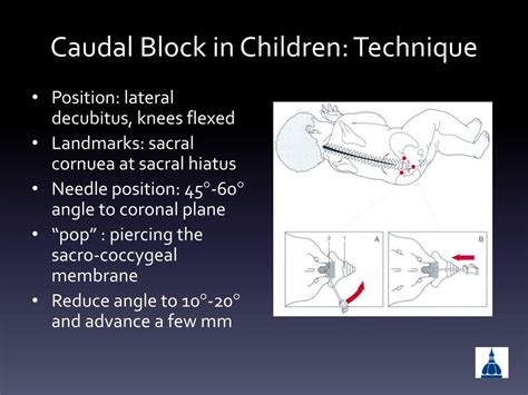 Indications typically, epidural injections are performed in patients who are currently not surgical candidates. PPT - Kiddie-Caudals Caudal Epidural Analgesia in Everyday ...