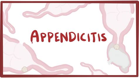 Appendicitis Causes Symptoms Diagnosis Treatment And Pathology Youtube