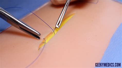 Subcuticular Suture Osce Guide Surgical Skills Geeky Medics