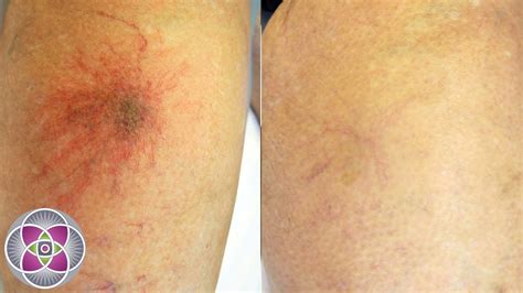 Laser Spider Vein Treatment On The Legs Youtube