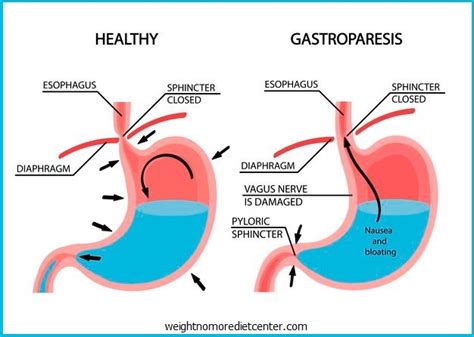 What Is Gastroparesis Weight★no★more℠ Diet Center