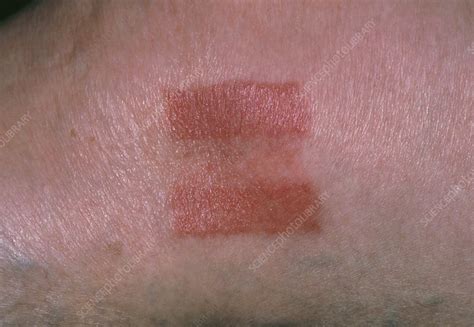 As allergic reactions become more. Skin rash caused by allergy to elastoplast - Stock Image ...