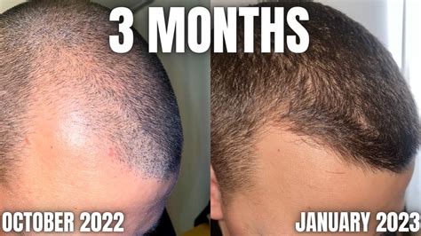 How To Get Insane Results With Finasteride Minoxidil And Derma Rolling