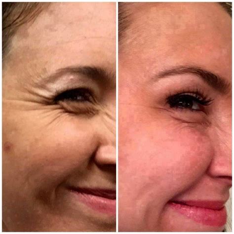 Dysport vs botox crow's feet, forehead, 11s, before & after, does it work, pain. Botox | Elegance Medical Aesthetics - Botox, Cosmetic and ...
