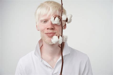 Czym Jest Albinizm Poznaj Przyczyny Tej Choroby Zdrowe Zdrowie