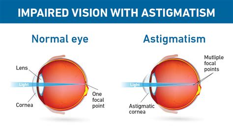 Astigmatism For Your Eyes Only