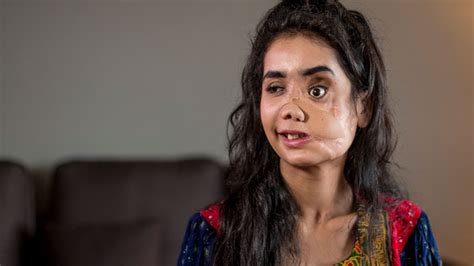 I Feel I Am Not Alone Anymore Afghan Woman Shot In Face By Her