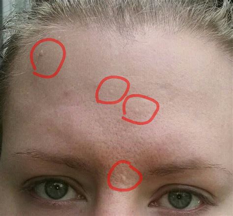 Skin Colored Bumps On Face Naturalskins