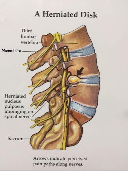 Herniated Disc Cervical Thoracic Lumbar Spinecare Medical Group My