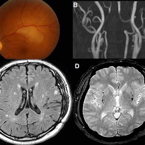 Representative Brain Mri Of Cerebral Small Vessel Disease In Patients