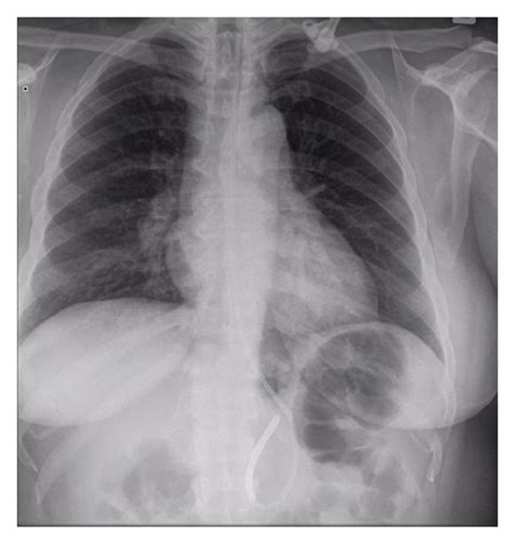 Chest X Ray Showing Hilar Lymphadenopathy Also Of Note Is A