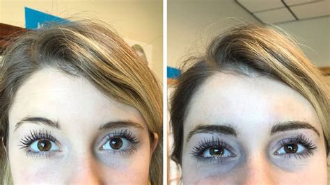 A combination of botox® cosmetic/dysport®/xeomin® and various dermal fillers such as radiesse®/juvederm®/sculptra®. Permanent Make-up | Uneven eyebrows, Fix eyebrows ...