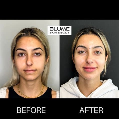 Dermal Fillers Before And After Photos Scottsdale Arizona