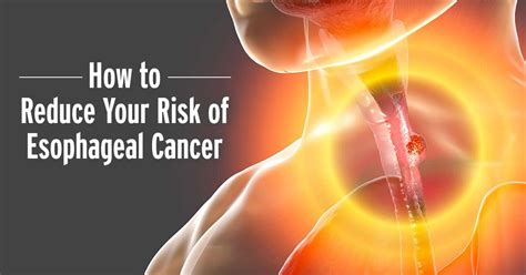 Esophageal Cancer Reduce Your Risk Russell Havranek Md