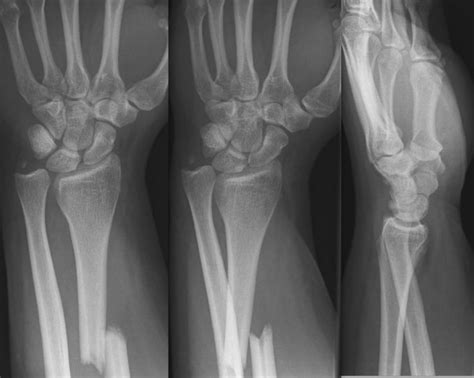 Galeazzi Fracture • Litfl • Medical Eponym Library