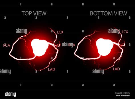 Coronary Angiography Hi Res Stock Photography And Images Alamy