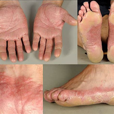Swollen Palms And Soles With Thick Infiltrated Hyperkeratotic Plaques