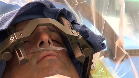 Deep Brain Stimulation Surgery To Treat Parkinsons Disease At Mount