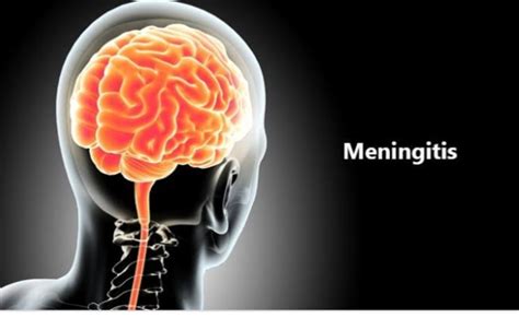 Meningitis Pathophysiology Sign And Symptoms Diagnostic Finding