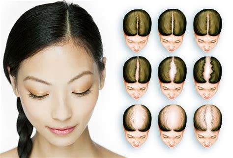Widening of the part 2. Women's Hair Loss Pictures: Causes, Treatments, and More