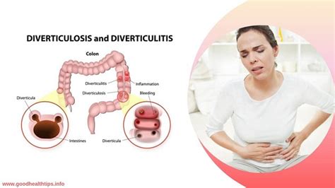 Diverticulitis The Cause Symptoms Diagnosis And Treatment Of This