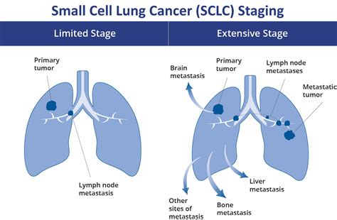 Small Cell Lung Cancer Sclc Staging Sclc Has 2 Stages Grepmed
