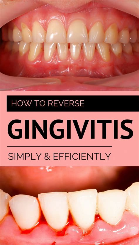 How To Reverse Gingivitis And Receding Gums Unugtp