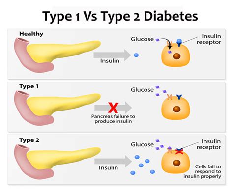 Types of Diabetes - Type 1, Type 2 Diabetes & Gestational Diabetes