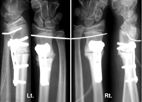 Radiographs After Corrective Osteotomy And Temporary K Wire Fixation Of