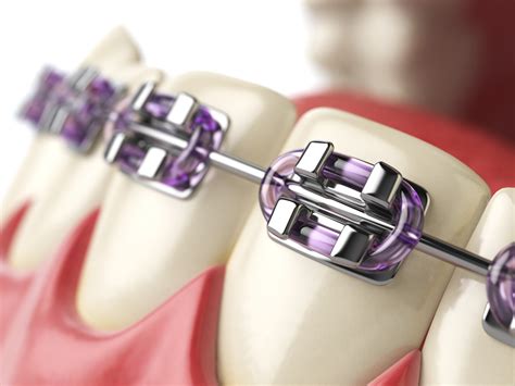Bite Correction With Dental Braces Your Options And What It Costs
