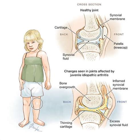 Juvenile Idiopathic Arthritis Pediatrics Jama The Jama Network