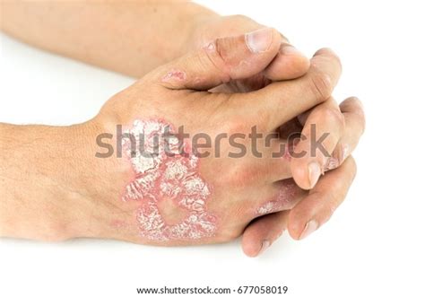 Psoriasis Vulgaris Dermatitis On Male Hands Stock Photo 677058019