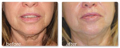 St Sagging Jowls59yr 3tx Ronit Addi Medical Aesthetic Center Crop