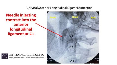 Is The Anterior Longitudinal Ligament Causing You Neck Pain