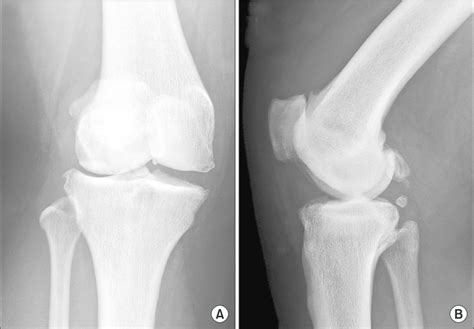 Preoperative Radiographs Of The Right Knee A Anteroposterior View