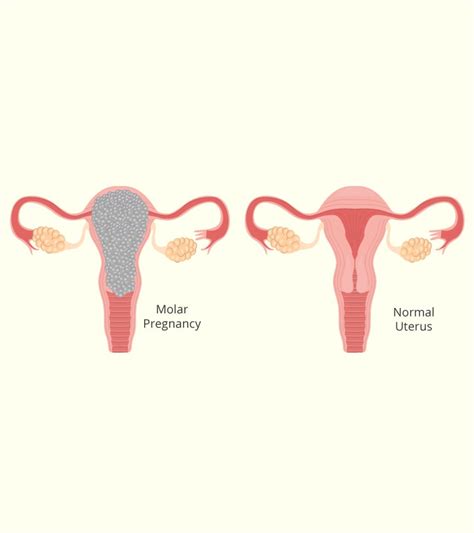 Molar Pregnancy Types Symptoms Causes And Treatment