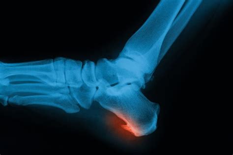 Heel Spurs Causes Symptoms And Treatment Sanders Podiatry