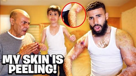 Fake Skin Peeling Prank On My Dad Youtube