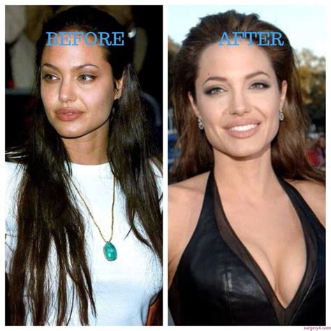 Angelina Jolie Breast Implants Photos Before After Surgery