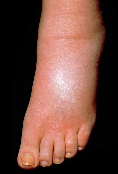 A Swollen Foot In A Case Of Pitting Oedema Photograph By Science Photo