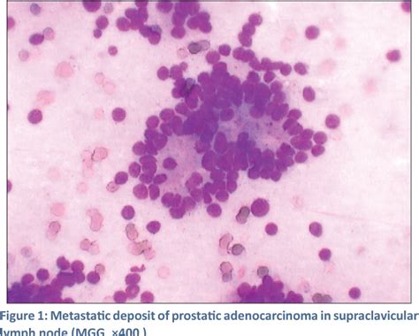 Figure 1 From Fine Needle Aspiration Cytology Of Supraclavicular Lymph