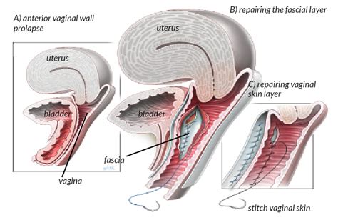Figure Anterior Vaginal Wall Repair Website Your Pelvic Floor