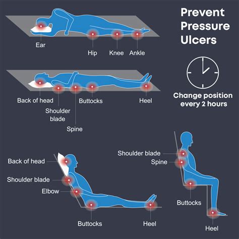 Pressure Ulcer Sites Diagram Wiring Diagram Images