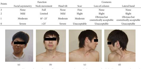 figure 1 from a surgical treatment for adult muscular torticollis semantic scholar