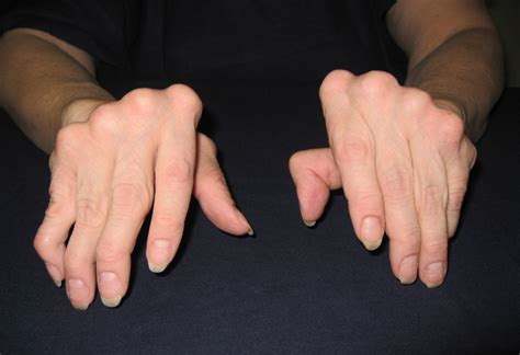 Typical Ulnar Deviation Of Rheumatoid Arthritis Pronation Rheumexam