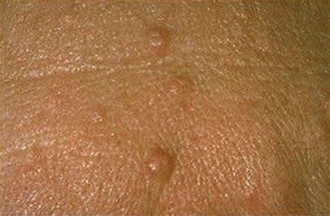 👉 Sebaceous Hyperplasia Pictures Removal Symptoms Treatment