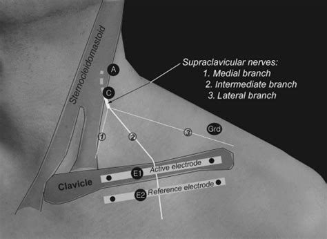 Proximal Nerve Conduction Studies In Upper Extremity And Cervical